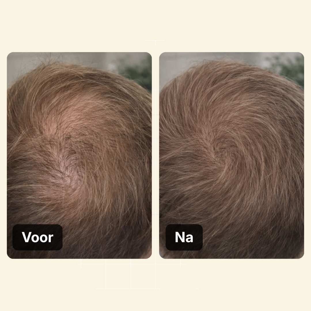 Haarlijn Booster